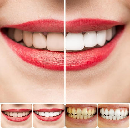 New SP-4 Ultra+ Whitening Teeth (Pack of 1) 🦷✅